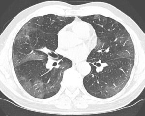 Tomografia do tórax de paciente com Covid-19, mostrando o acometimento pulmonar da pneumonia viral, com opacidades em vidro fosco (áreas mais brancas) multifocais, periféricas e bilaterais