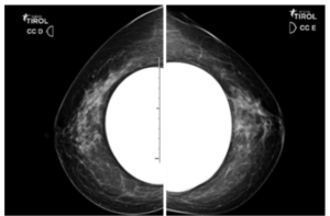 Mamografia de Seio com Silicone