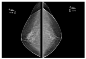 Mamografia de um Seio Normal