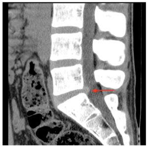 A e B. Ressonância magnética (T1) evidenciando hérnia discal