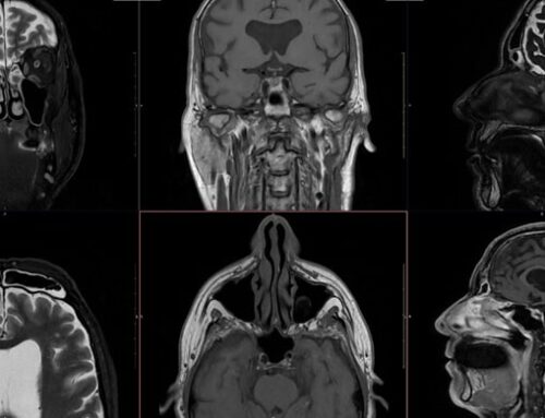 Ressonância magnética da face: exame preciso para detectar tumores na faringe e glândulas salivares