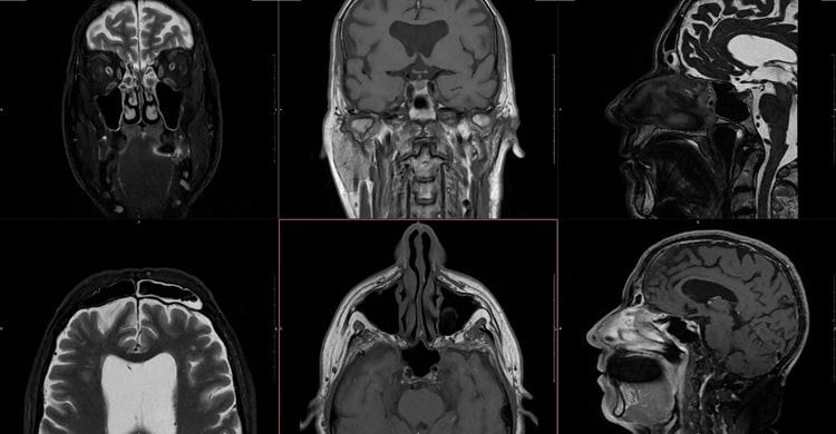ressonância magnética da face