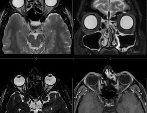 Ressonância magnética de órbitas: quando é indicada e o que o exame pode diagnosticar