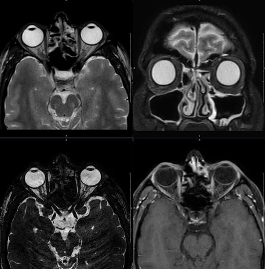 Ressonância magnética de órbitas